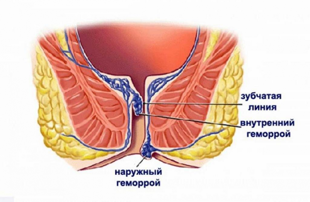 Геморрой: симптомы, фото, лечение. Как лечить геморрой